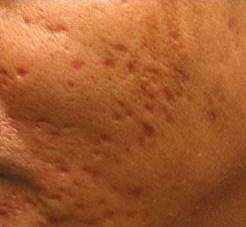 Scars Acne Before Treatment